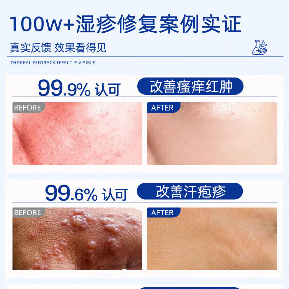 凡速平医用退热凝胶汗疱疹止痒根去水泡角化型带状缠蛇腰潮湿瘙痒 3盒装