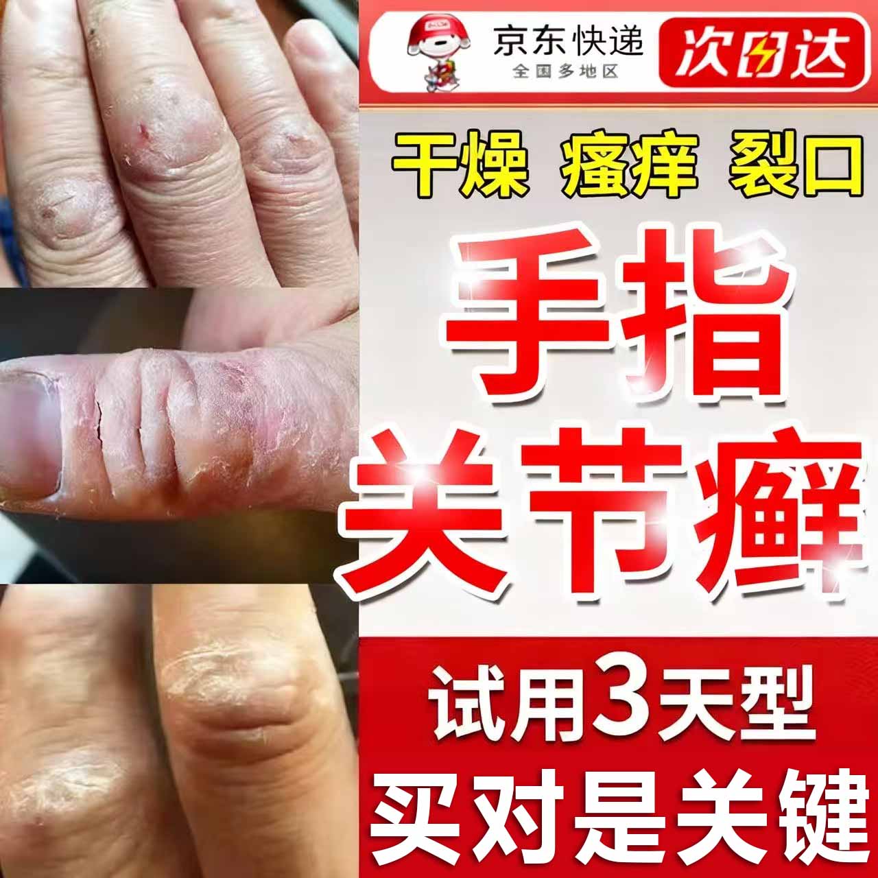 手癣手足脱皮手指缝溃烂止痒搭治疗手足粗糙掉皮去硬疙瘩硬块专用膏