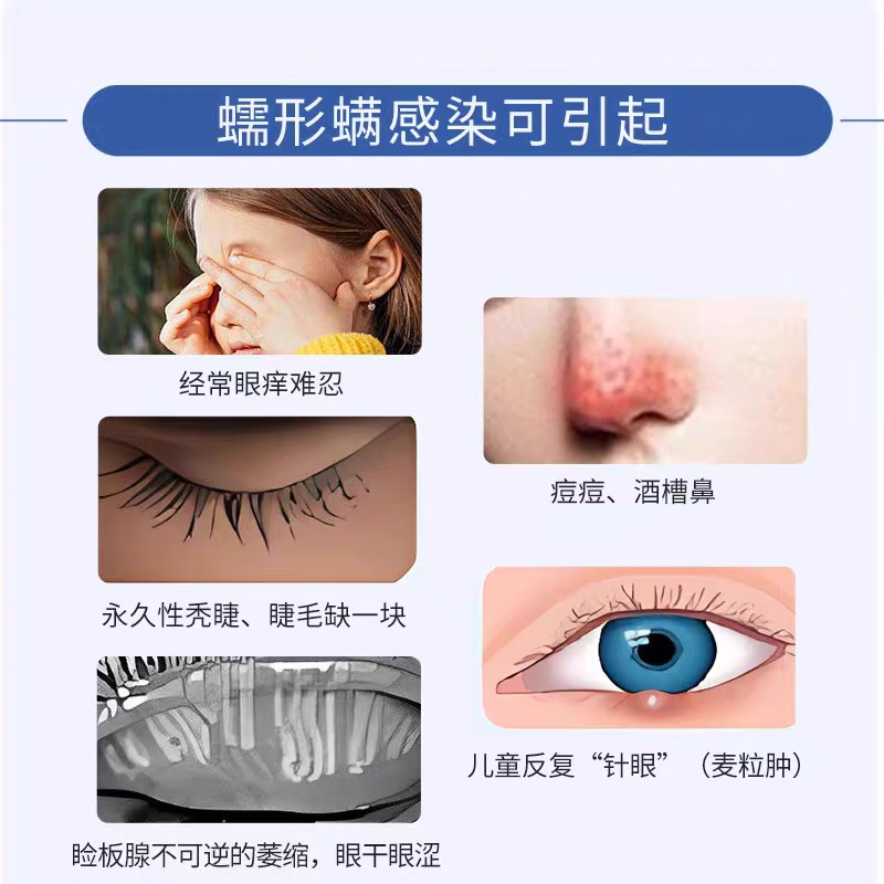 眼医生特奈斯4松油醇除螨棉片百分之一浓度16.2纳米制剂30片装正品 c型8乘10