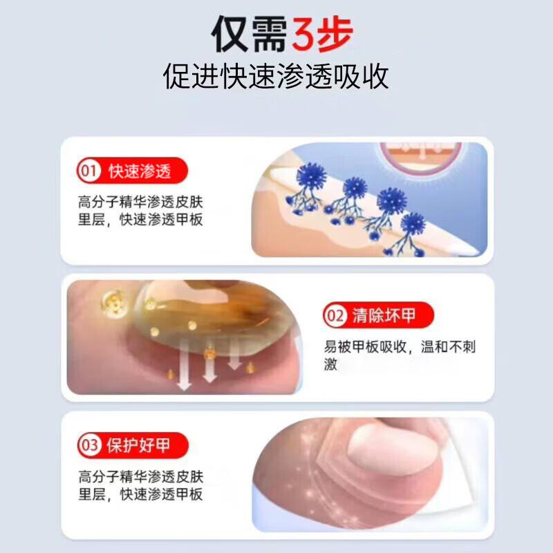 SOS德国原装进口指甲笔4ml抑菌液软甲膏甲外用脚气水升级款灰指甲笔 sos抑菌指甲笔 3ml 1盒 (热销)硬笔头