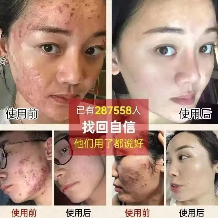同仁堂青少年祛痘膏修复淡化痘印祛痘凝胶淡化痘坑学生凝胶霜男女青草膏 青少年祛痘膏 1支
