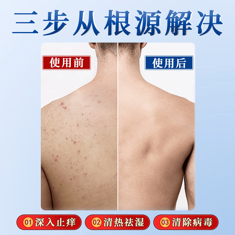 日本化藥【一抹止痒】日本特效炉甘石皮肤干痒抑菌润肤乳全身适用止痒药膏 1瓶【3秒止痒】 湿疹特效的药止痒去根