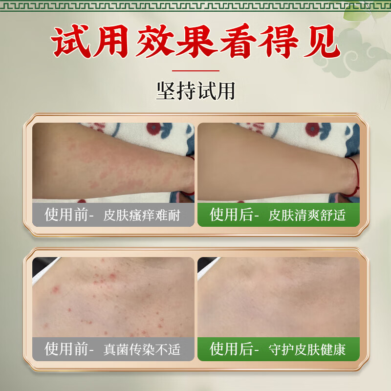 香港大药房有限公司真菌王皮肤瘙痒真菌感染私处抑菌阴囊潮湿大腿内侧肛门男女通用  1瓶【严重真菌感染】不划算