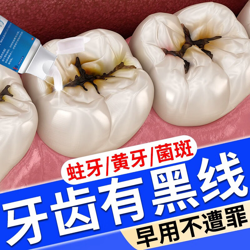 修正防蛀牙膏蛀牙洞修复龋齿医用成人儿童青少年含氟杀虫牙洞清理烂牙
