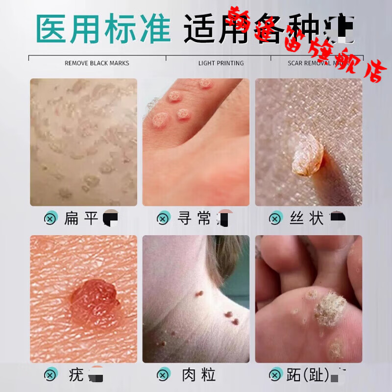 五妙水仙乳膏国药准字号扁平i疣专用膏去i疣瘊小肉粒其他身体护理 3盒周期装【适用中度症状】买2送1 【官方授权】