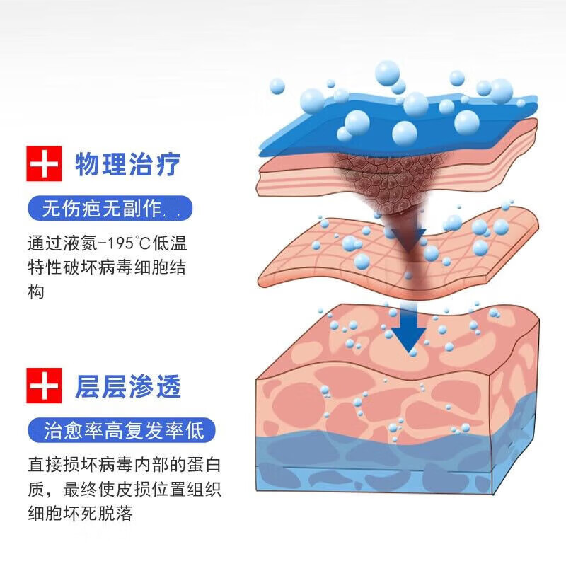 液氮冷冻疣医用液尖锐湿疣寻常疣物理疣跖疣肉粒疙瘩刺 液氮280ml+棉签+克疣液*1盒