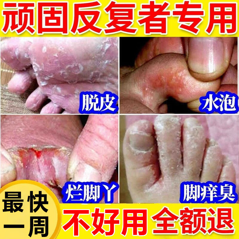 宫本武藏脚气喷剂止痒脱皮烂脚丫真菌感染脚痒脱皮水泡型脚痒100ml