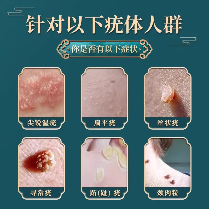 葵花祛疣凝胶去除疣体药膏丝状疣丝状疣脖子颈部扁平疣疣体脱落膏专用 特效一盒装【疣猴灵膏】