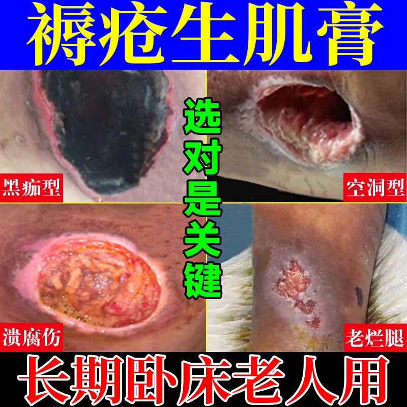 盛和道夫褥瘡膏褥瘡褥瘡貼傷口愈合褥瘡壓瘡皮膚潰爛去腐肉生肌膏老人臀部 單盒裝(50g)