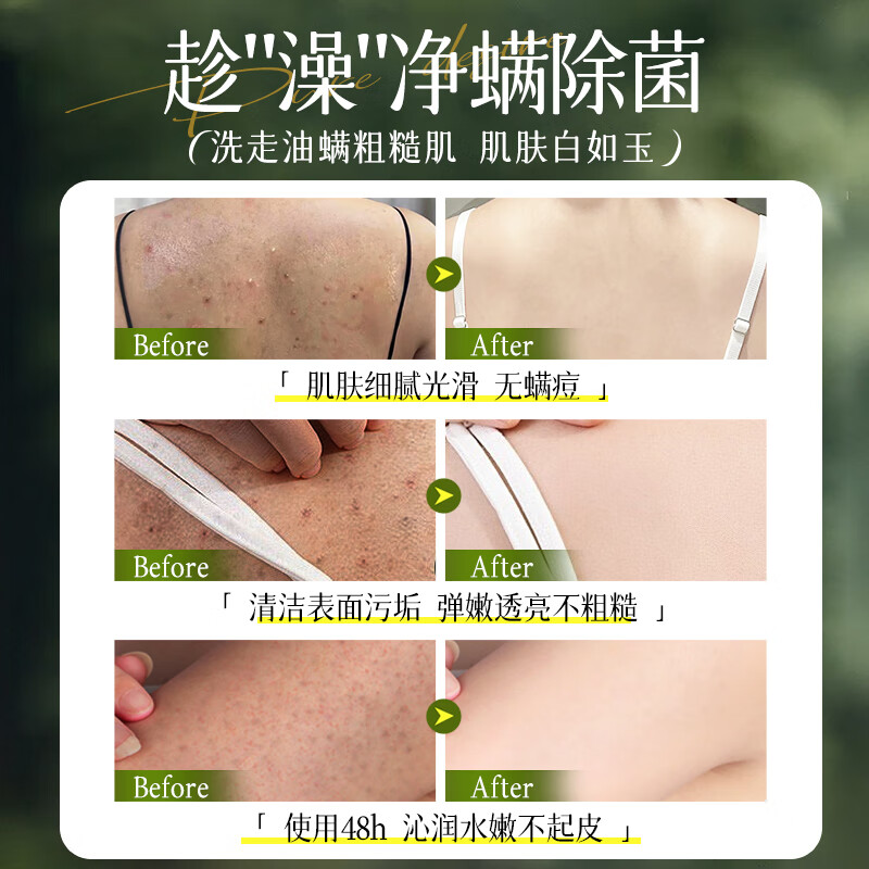 溥畔莜莜西子除螨沐浴露止痒祛痘控油去螨虫后背痘痘保湿液体香皂青少 [金标认证]儿童洗发沐浴二合一