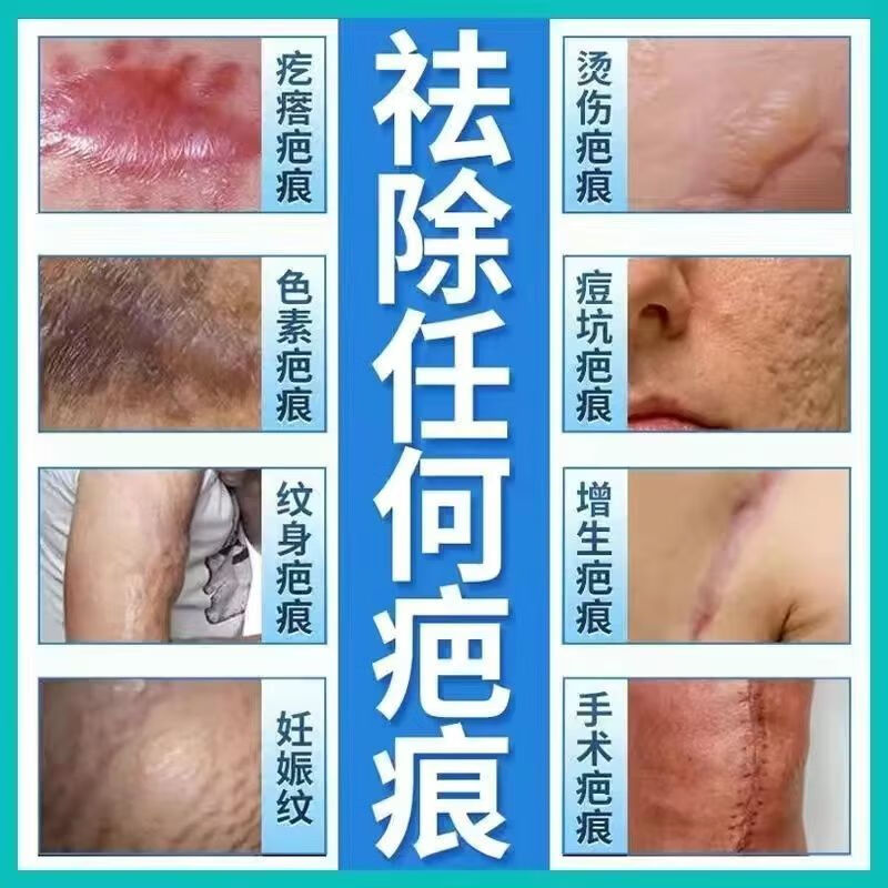 消除去疤膏老疤旧疤疤痕增生疤痕疙瘩凸起硬肉产后大腿纹 消除三年