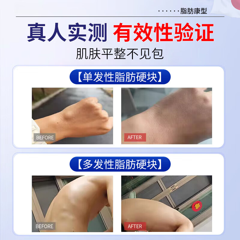 保元医生葆远红外治疗凝胶脂肪瘤消肿瘤消瘤膏去除神器囊肿硬块医 1盒装[慎拍不划算]