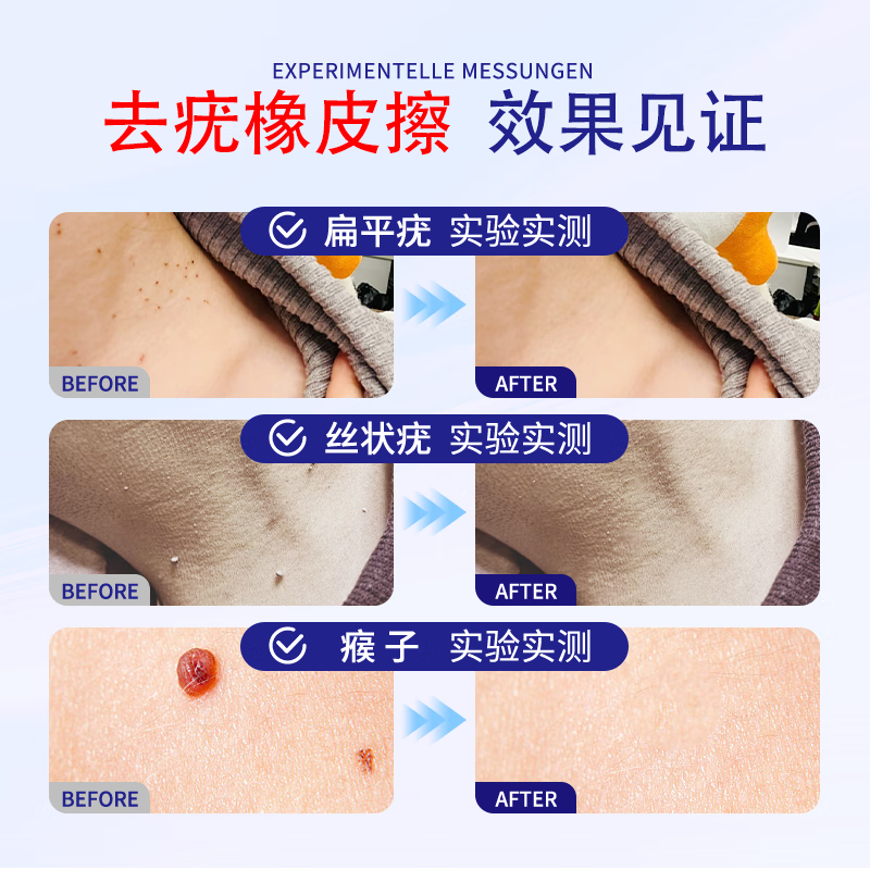DR.ADDO德国扁平疣专用去疣膏尖锐湿疣体脱落去脖子小肉粒祛疣软膏 1盒装【轻微疣体-专用特效】