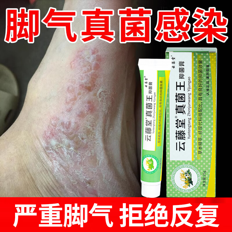 VKR 强效真菌王脚气膏真菌感染脚脱皮糜烂水泡烂脚丫脚汗脚臭止痒 1盒 【 强效杀菌止痒】