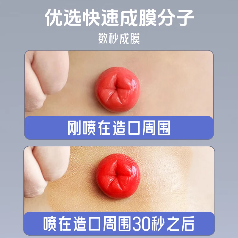 护士同学12020造口皮肤保护剂造口袋黏胶去除剂造口防漏圈造口护理四件套 造口皮肤保护剂12020液体敷料（ 50ml月度）