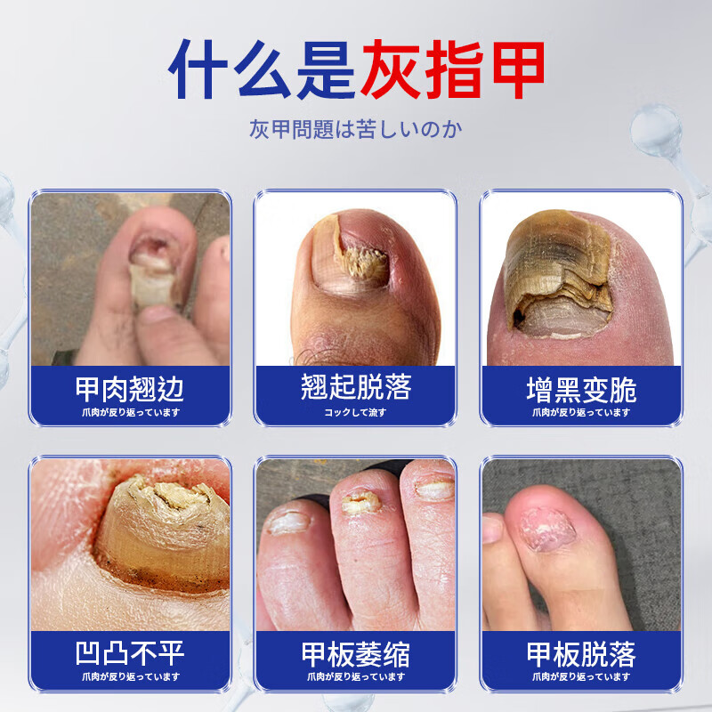 葛幸药房日本灰指甲100%特效专用的药重度灰指甲进口真菌感染坏甲发黄增厚 【根源去灰】灰指甲专用-1盒