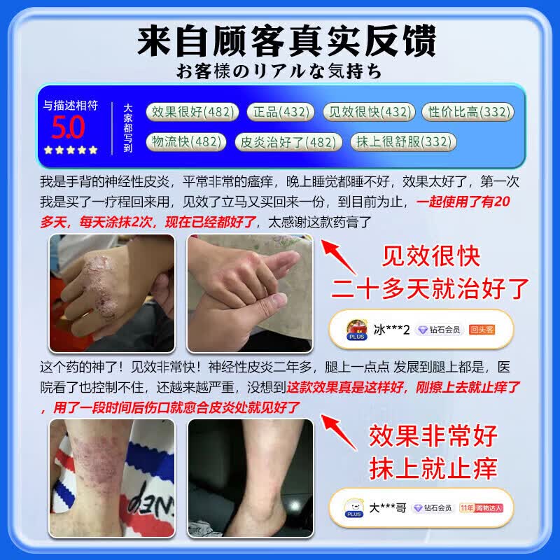 岩井昃弘神经性皮炎药皮肤瘙痒脂溢性皮炎湿疹脚气真菌王手足癣感染止痒膏 买三发五【永绝后患】不再犯 皮肤痒越抓越痒皮肤药膏