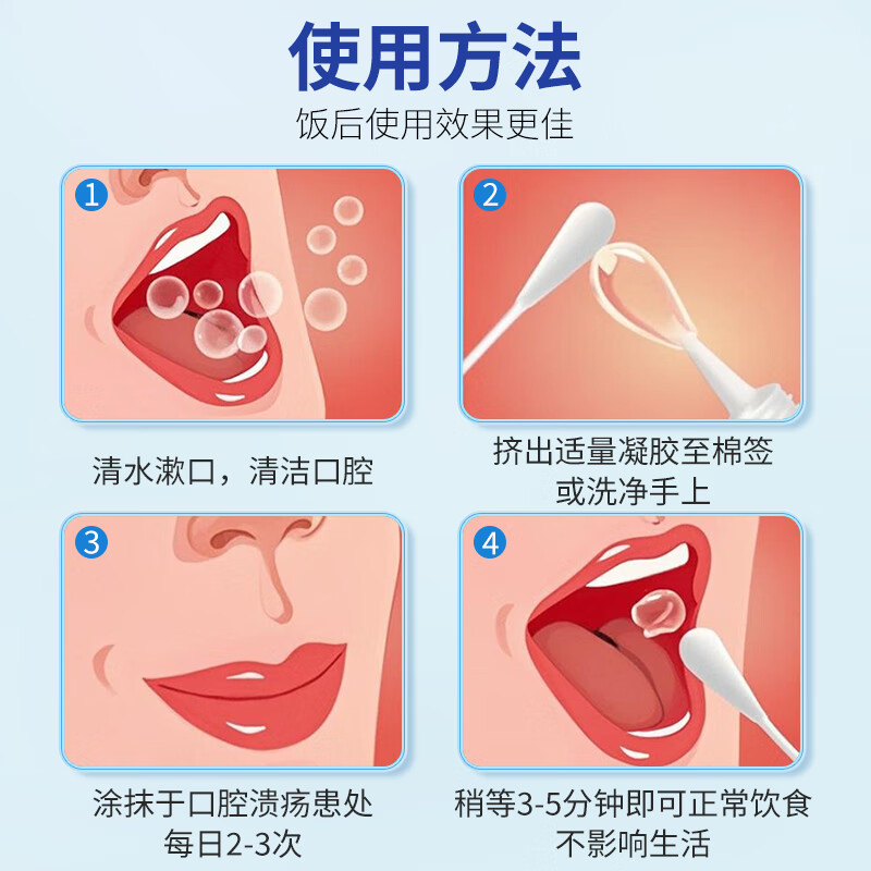 仁和医用口腔溃疡凝胶用于义齿或手术造成的创面疼痛口腔炎症上火起泡 4盒装/80g/用于缓解口腔溃疡疼痛