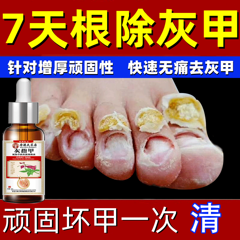 香港大药房灰指甲第1名药灰指甲专用指甲真菌感染脱甲坏甲新亮甲根i治抑菌液 1盒装【1-2个推荐】