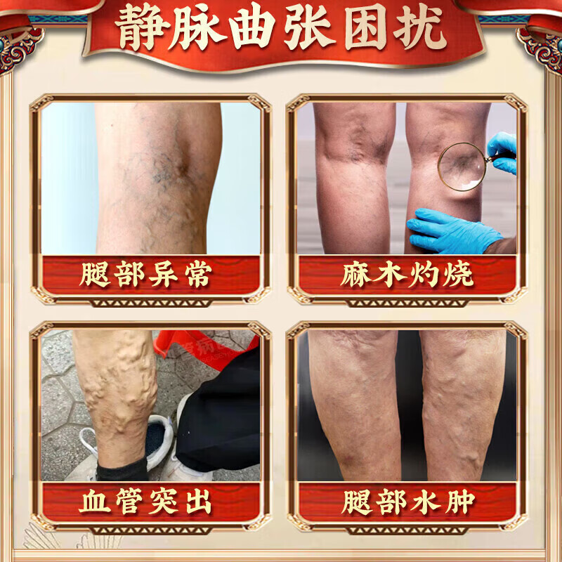 北京协和医学院静脉曲张专用膏药蚯蚓腿疏通血管堵塞进口药冷敷凝胶治疗静脉舒膏 特效1盒【静脉曲张专用】 特效静脉曲张喷雾专用贴的