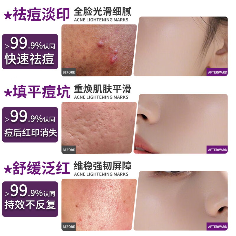 安碧媞(新客)祛痘印疤痕提亮修复医用三型人源化胶原蛋白修护液5支装 浅紫色 无菌型