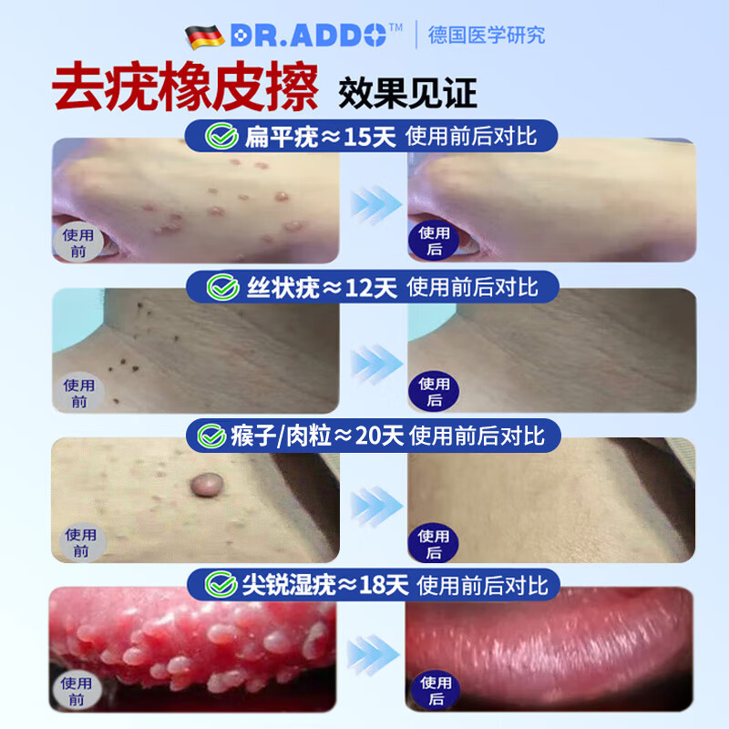 DR.ADDO去除疣祛疣体脱落药膏尖锐湿疣扁平疣丝状疣脖子肉粒颈部专用的药 1盒体验装【医用祛 疣体肉粒疙瘩】 去除疣体药膏疣体脱落膏扁平疣丝状疣专用的药京棟自蓥