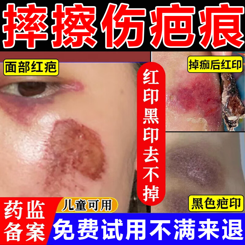 摔伤擦伤祛疤膏去除黑印脸部腿部摔伤破皮祛疤痕可大专用修复膏除疤去