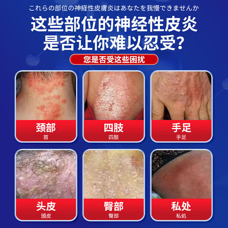 岩井昃弘神经性皮炎药皮肤瘙痒脂溢性皮炎湿疹脚气真菌王手足癣感染止痒膏 买三发五【永绝后患】不再犯 皮肤痒越抓越痒皮肤药膏