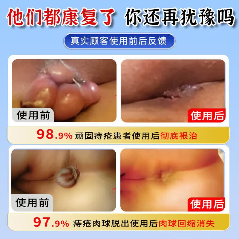 岩井昃弘痔疮凝胶100%特傚效专用膏药去i肉球内外混合痔疮去i肉球根断消痔 1支装【内外痔专用膏药】日本断痔膏