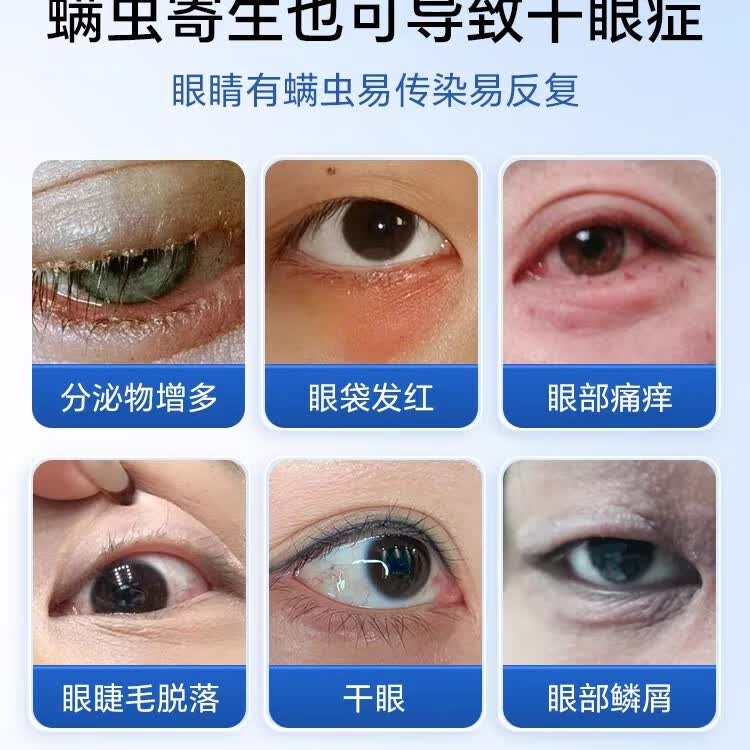 加视利加视利巾四松醇眼部清洁湿巾除螨虫14片装 4松油醇除螨湿巾 1片*14袋