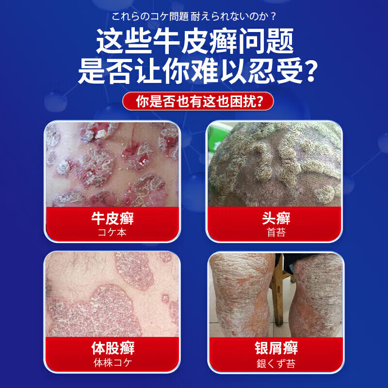 岩井昃弘牛皮癣100%专用的药膏真菌止痒抑菌皮肤顽固牛皮癣银屑病进口膏药 特效1盒【专攻牛皮癣】当晚消除 牛皮癣生物制剂 真菌王