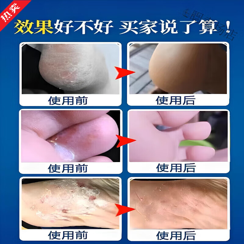 露卿沐脚起水泡真菌感染止痒脚丫脱皮糜烂水泡脚趾缝痒护理 一盒【体验装】 官方直售