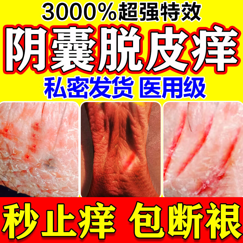 阴囊脱皮痒干燥起鳞片白花花皮屑男性下体潮湿疹蛋蛋止痒去i根药 特效