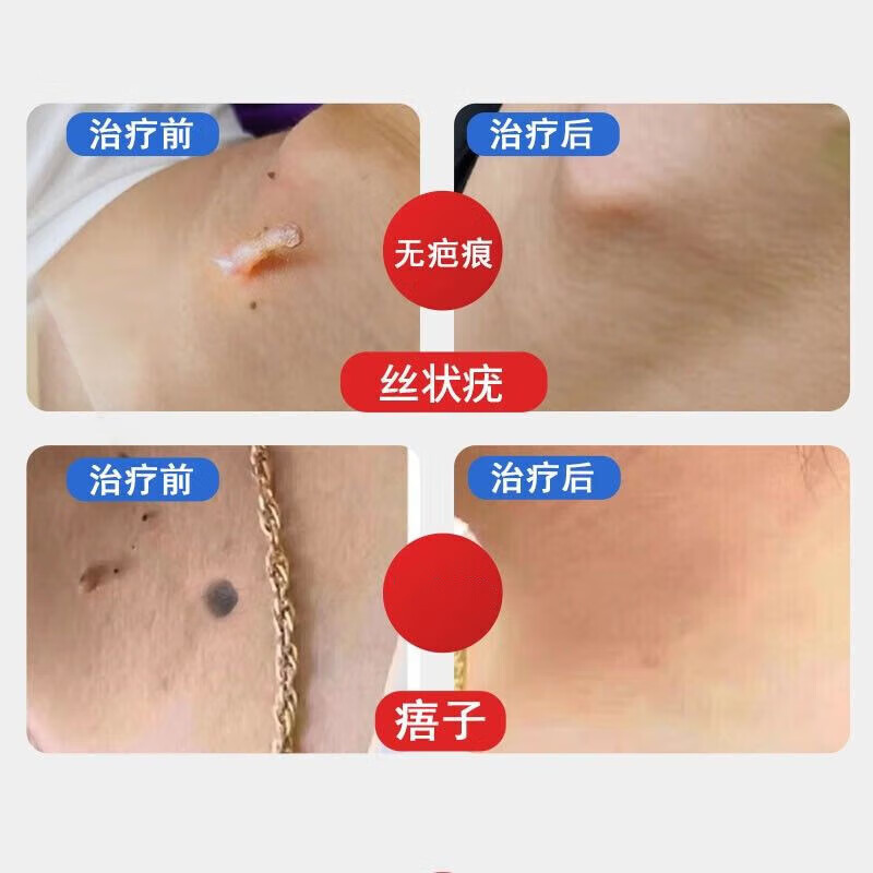 液氮冷冻疣医用液尖锐湿疣寻常疣物理疣跖疣肉粒疙瘩刺 液氮280ml+棉签+克疣液*1盒