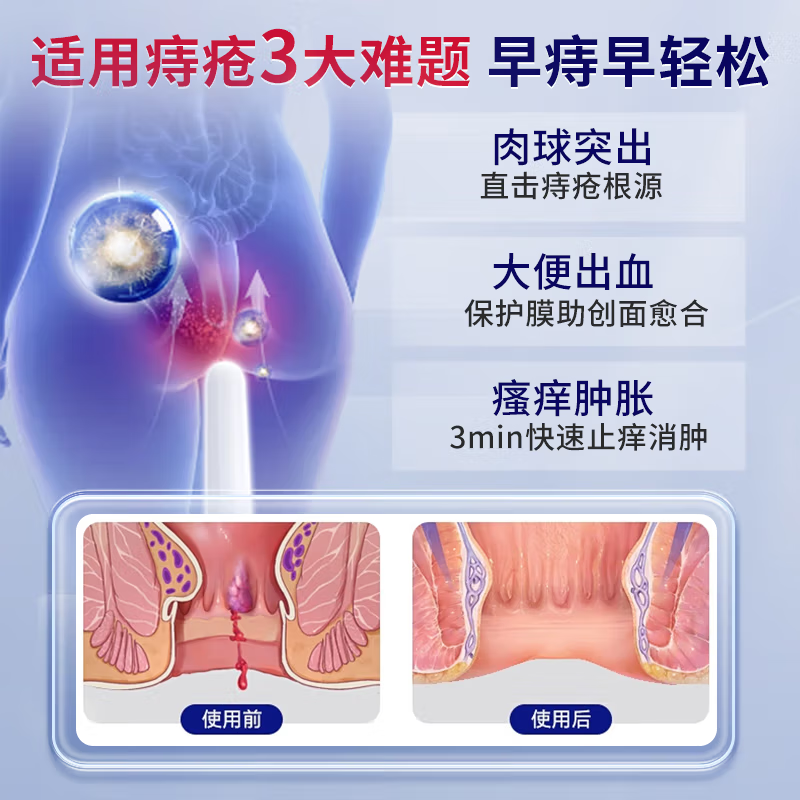 DR.ADDO痔疮膏去肉球内外混合痔疮专用特痔疮药卡波姆痔疮凝胶去肉球断根 1盒体验装【肛周瘙痒/轻微疼痛】100%特药 痔疮凝胶100%特专用的药京栋自蓥旗舰店痔疮药栓