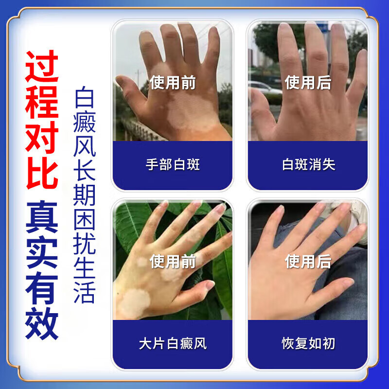 岩井昃弘日本进口白癜风药膏专用促进黑色素生长修复治白斑皮肤病遮盖液 特效买5送4【500%彻底冶裉】神奇 贝兰洁保健膏复方补骨脂酊医外用