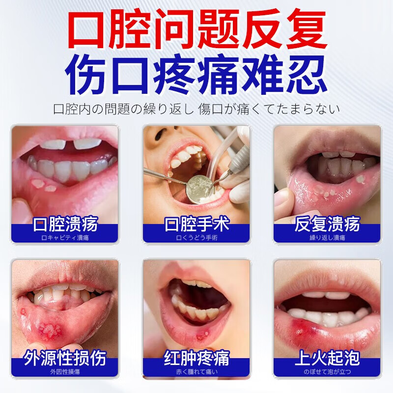 港村制药口腔护理保健液溃疡喷雾剂溃疡喷雾剂凝胶上火起泡口舌 5瓶装 买三赠二【巩固装】 【官方直售 京质保障】
