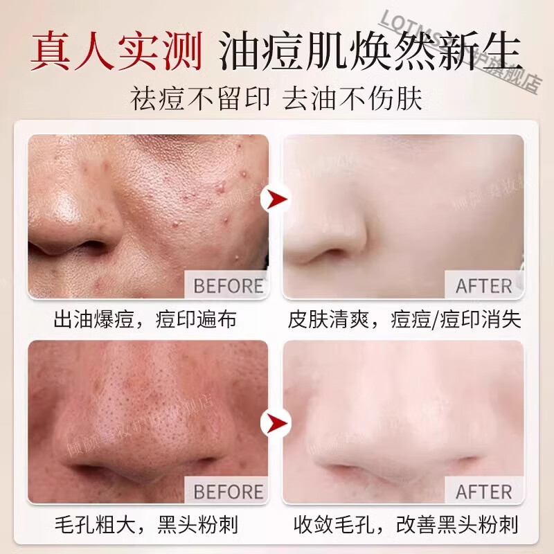 LQTMSZ倾轻颜硫磺洗面奶乳皂去收缩毛孔黑头粉刺控油 三支装