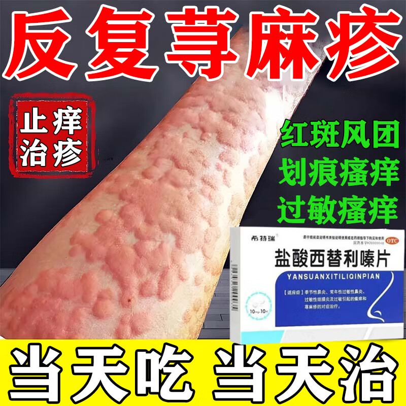 盐酸西替利嗪片荨麻疹专用药过敏止痒反复荨麻疹过敏瘙痒荨麻疹药膏