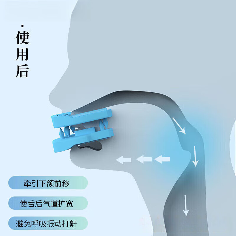 通用止鼾牙套 止鼾牙套打呼噜神器防呼噜防止打鼾 TH物理止鼾器(1牙套