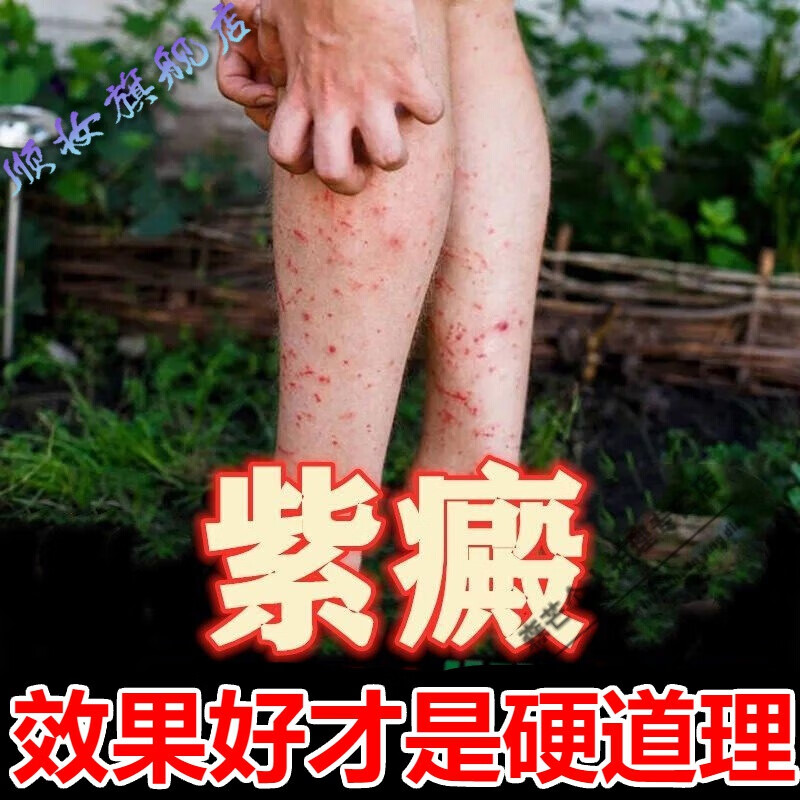 idgc官方过敏性紫癜膏血小板小儿老年性瘀滞皮下出血紫癜性皮ii炎 1盒