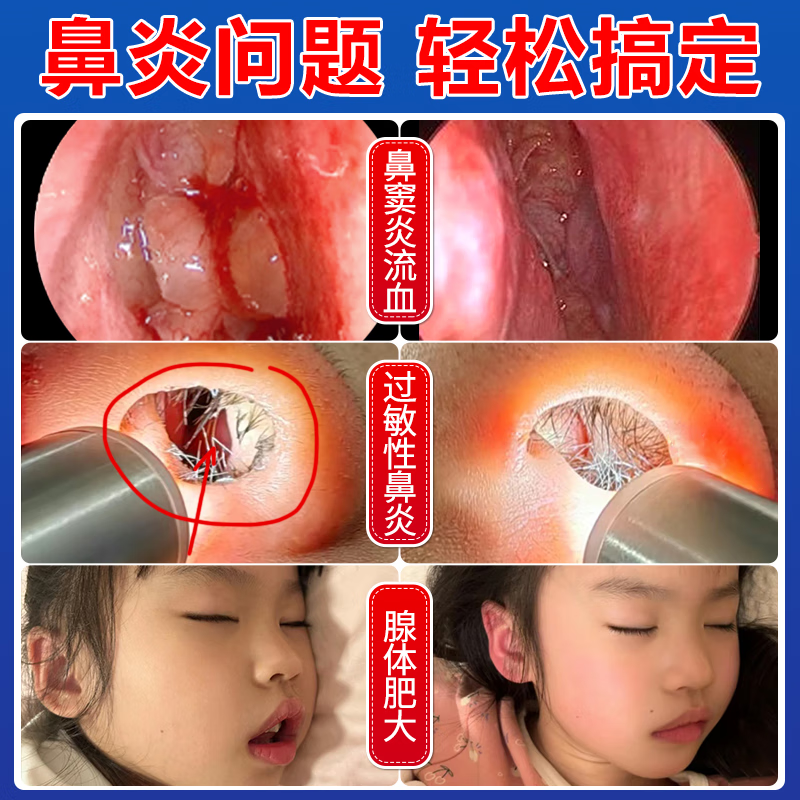 修正远红外鼻敏贴鼻炎鼻贴过敏性鼻炎鼻窦炎鼻甲肥大鼻塞通鼻膏药贴xl 超值1盒体验装【升级款】
