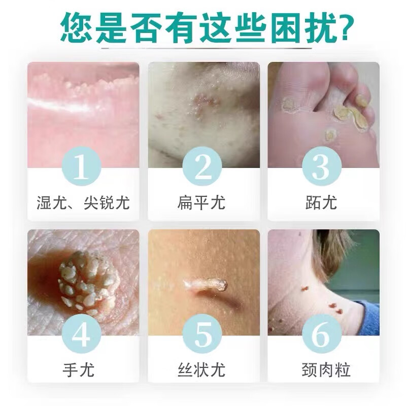 香港大药房氟尿嘧啶软膏乳膏除祛疣肉粒丝状官方正品20g 20g 1盒 1盒装[体验装]