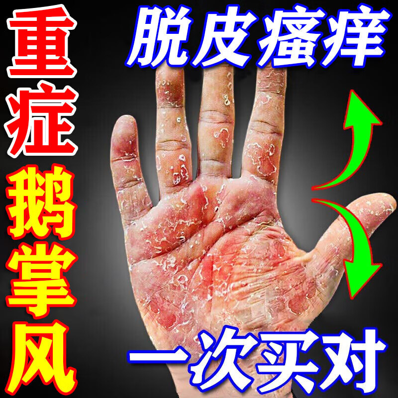 鹅掌风专用手癣膏非药治疗手掌干开裂脱皮 特惠:拍一发三