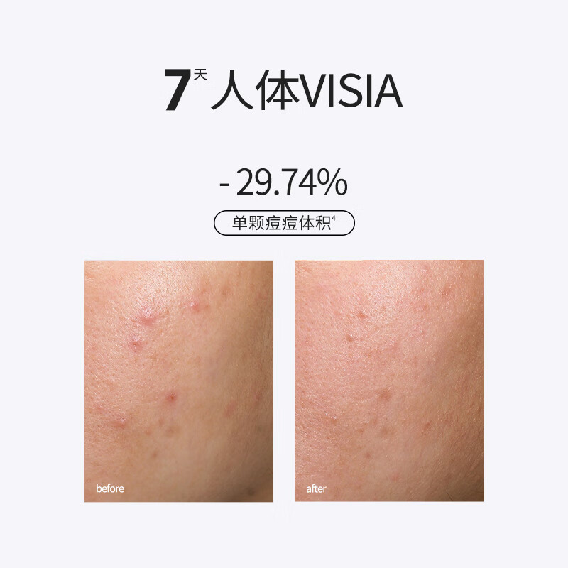 SOUNDER ONE20%壬二酸密集焕颜乳霜 控油祛痘保湿舒缓护肤品送女友