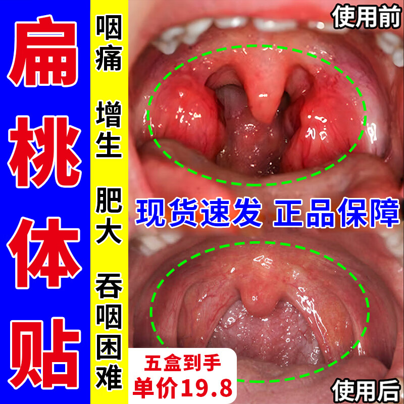 欧修堂 扁桃体发炎肥大肿大中药贴膏儿童喉咙发炎咽喉肿痛扁桃体炎喉咙痛咽痛穴位贴 5盒【周期装】T单盒低至19.8