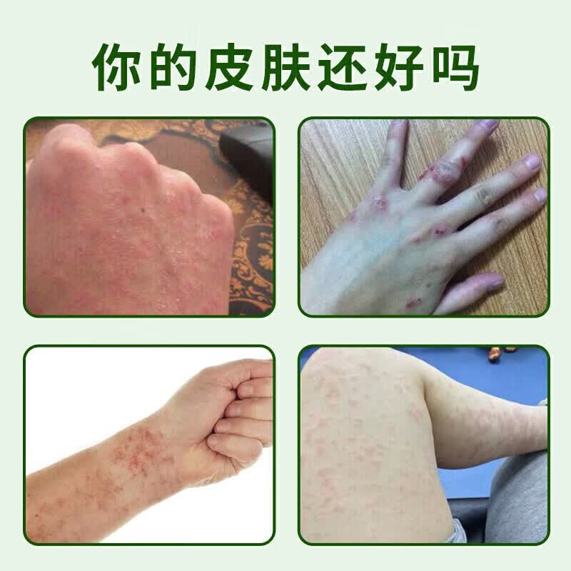 [丽珠]荆肤止痒颗粒 3g*10袋 1盒装 荆肤止痒颗粒荨麻疹专用国药正品止痒抑菌皮肤瘙痒身体痒荨麻疹湿疹进口服止痒去过敏 荨麻疹皮肤瘙痒止痒用药