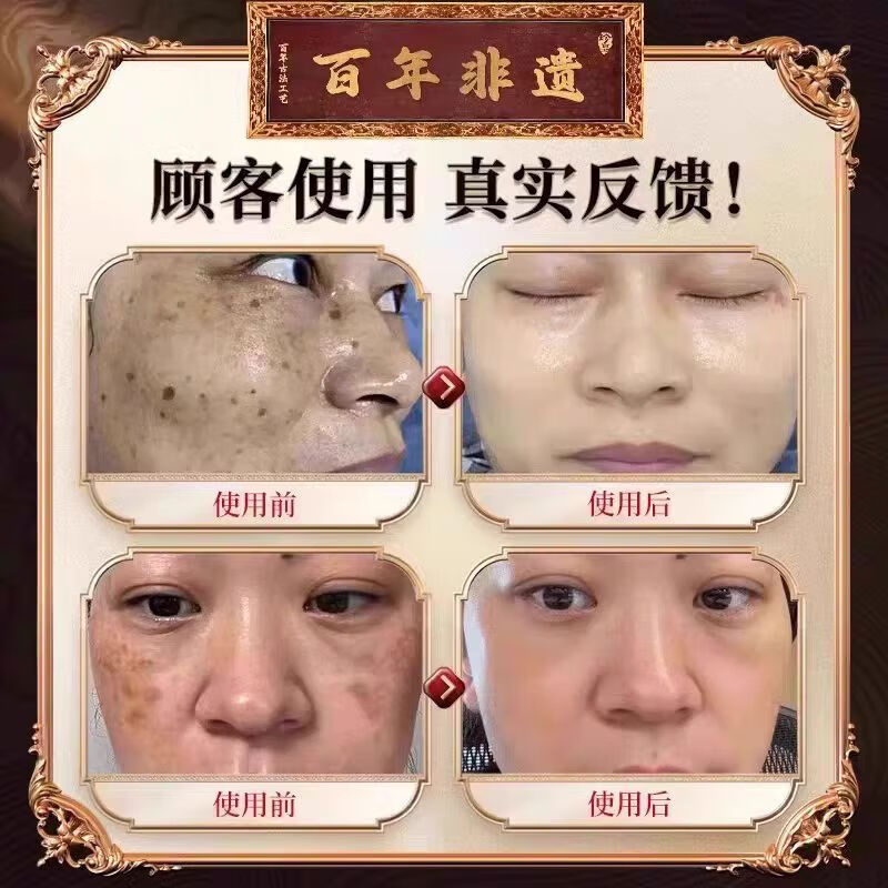 贝因维丝卡唯朵美白祛斑霜杨姐养肤草本堂直播同款淡斑老年斑阳阳官方正品 三盒加强版霜疗程装【中度斑点】科学淡斑 官方直售