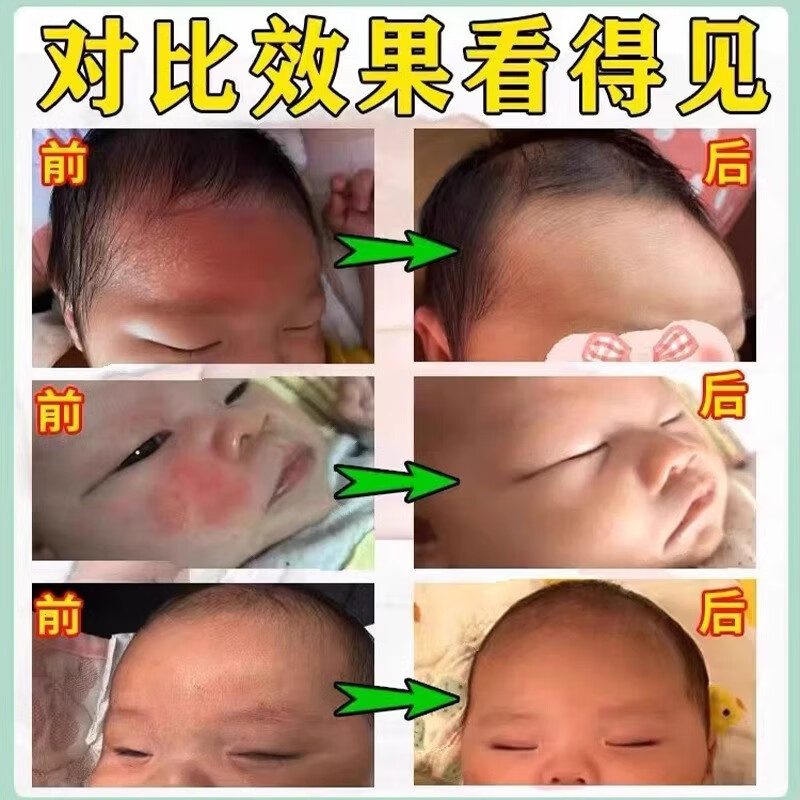 葵花夏季热痱子水祛痱止痒喷雾痱子粉婴儿专用止痒祛热痱子男士爽身粉 特效:一盒体验装