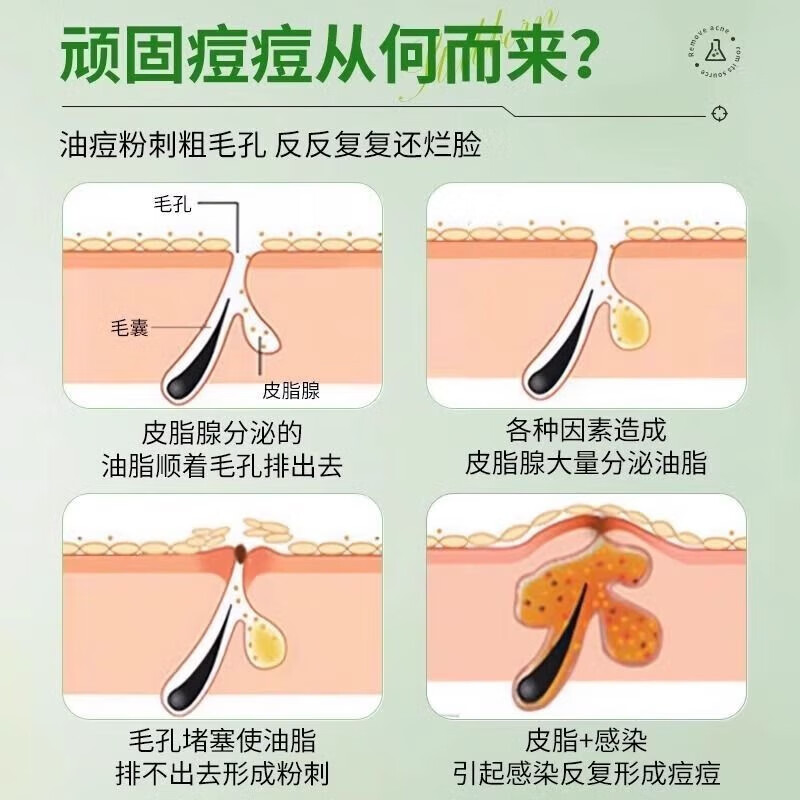 内廷上用北京同仁堂水杨酸祛痘凝胶淡化痘印温和去粉刺闭口改善黑头凝胶H 【1盒体验装】15g/盒